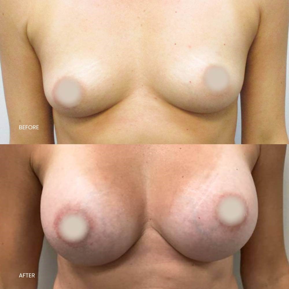 Happy patient surgery Savings
