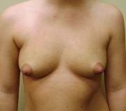 Breast Enlargement