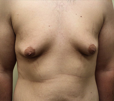 Male Breast Reduction