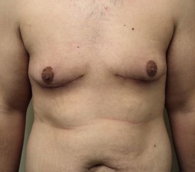 Male Breast Reduction