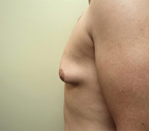 Male Breast Reduction Results Tallahassee