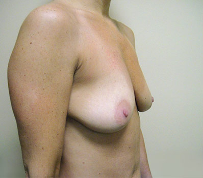 Breast Enlargement