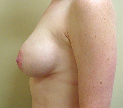 Breast Lift with Implants