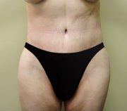 Body Lift & Belt Lipectomy