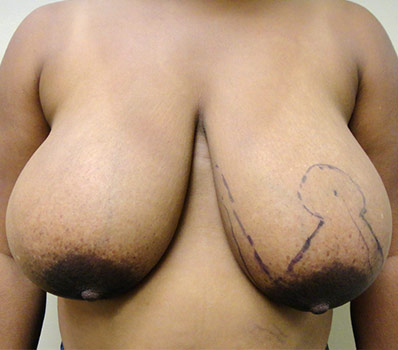 Breast Reduction