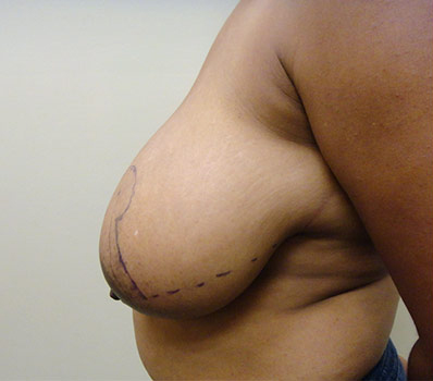 Breast Reduction