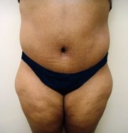 Tummy Tuck Results Tallahassee