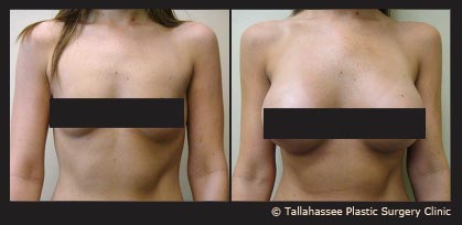 Breast Augmentation Before and After Photo - Tallahassee Plastic Surgery Clinic